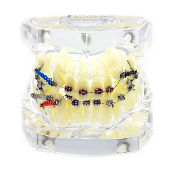 Демонстрационная ортодонтическая модель челюсти с металлическими брекетами и минивинтами, патологический прикус, прозрачная